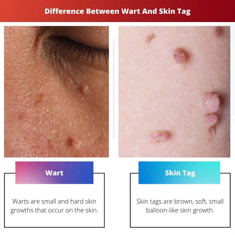 Difference Between Wart And Skin Tag