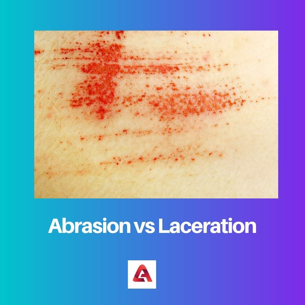 Abrasion vs Laceration