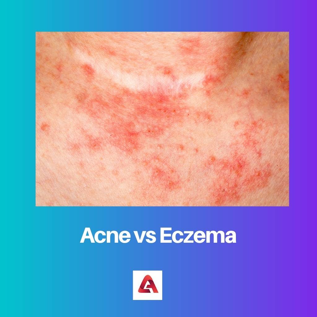 Mụn vs Eczema