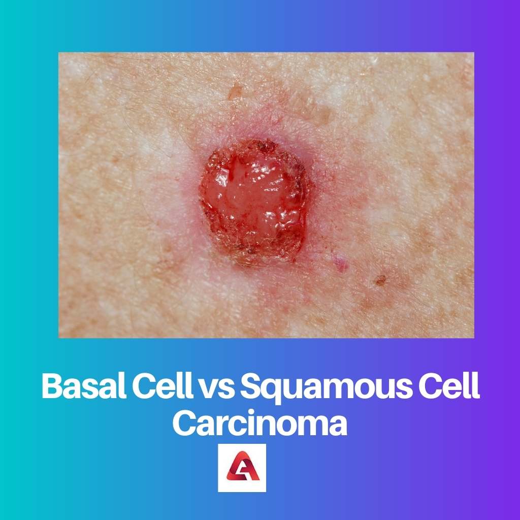 Basal Cell vs Squamous Cell Carcinoma