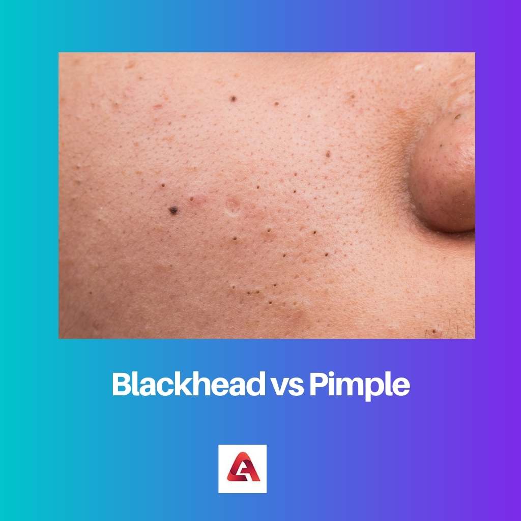 Blackhead vs Pimple
