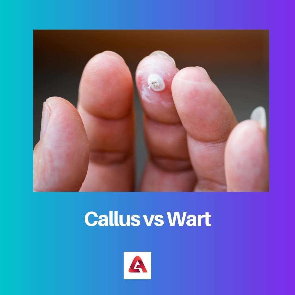 Callus vs Wart