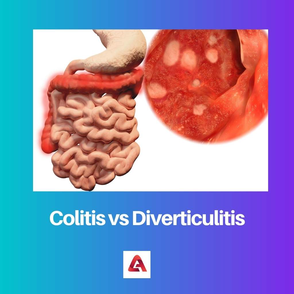 Kolitis vs Divertikulitis