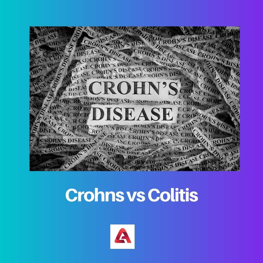 Crohn versus colitis