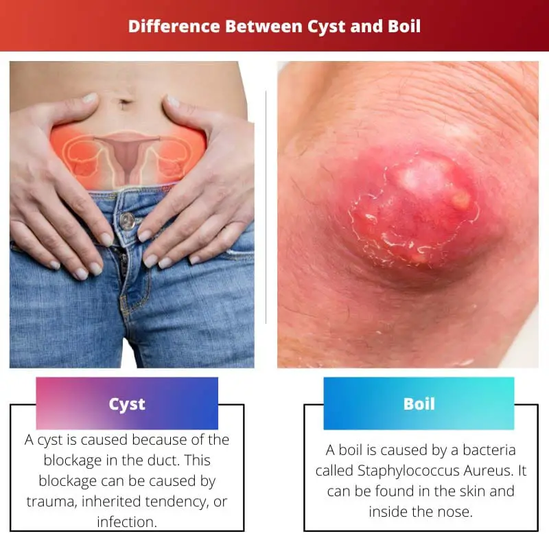 Difference Between Cyst and Boil