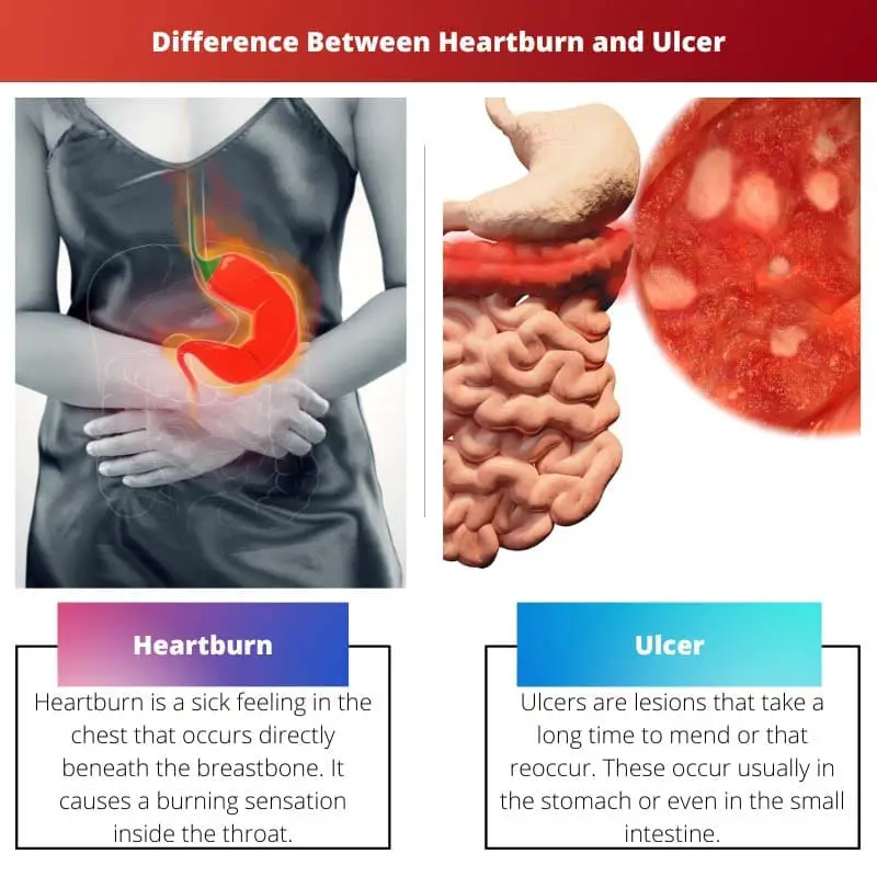 Differenza tra bruciore di stomaco e ulcera
