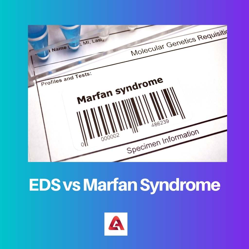 EDS vs Marfan Syndrome