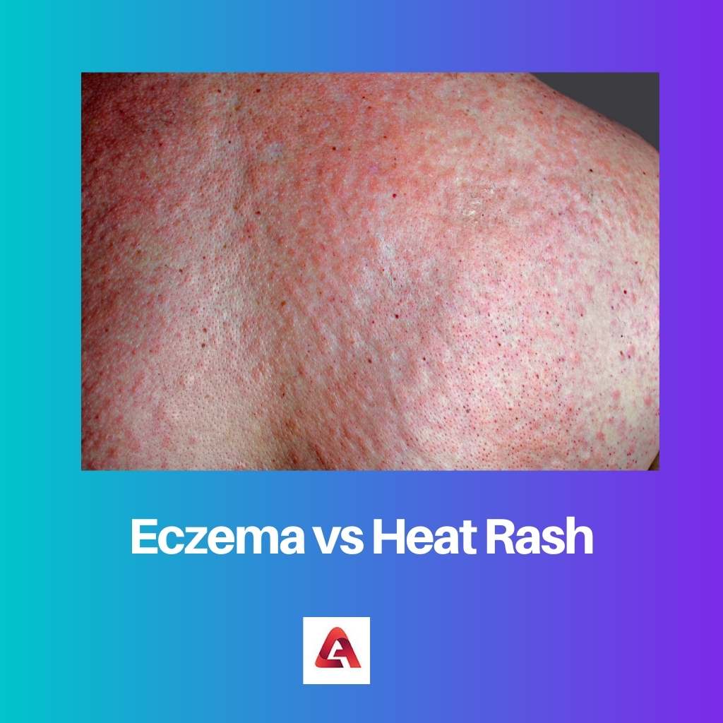 Eczema vs Heat Rash