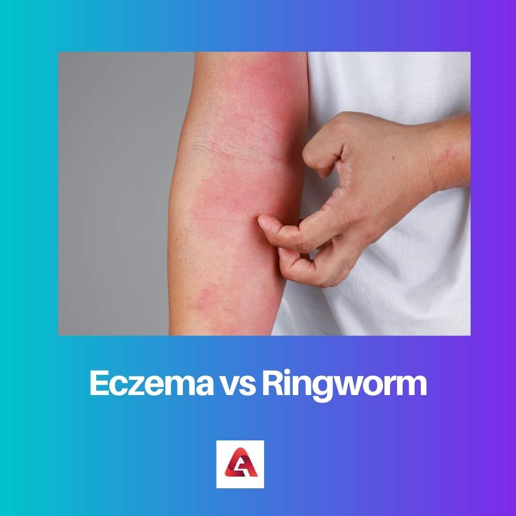 Eczema vs Tiña