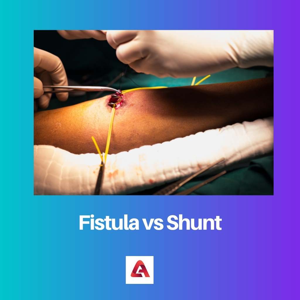 Fistula vs Shunt