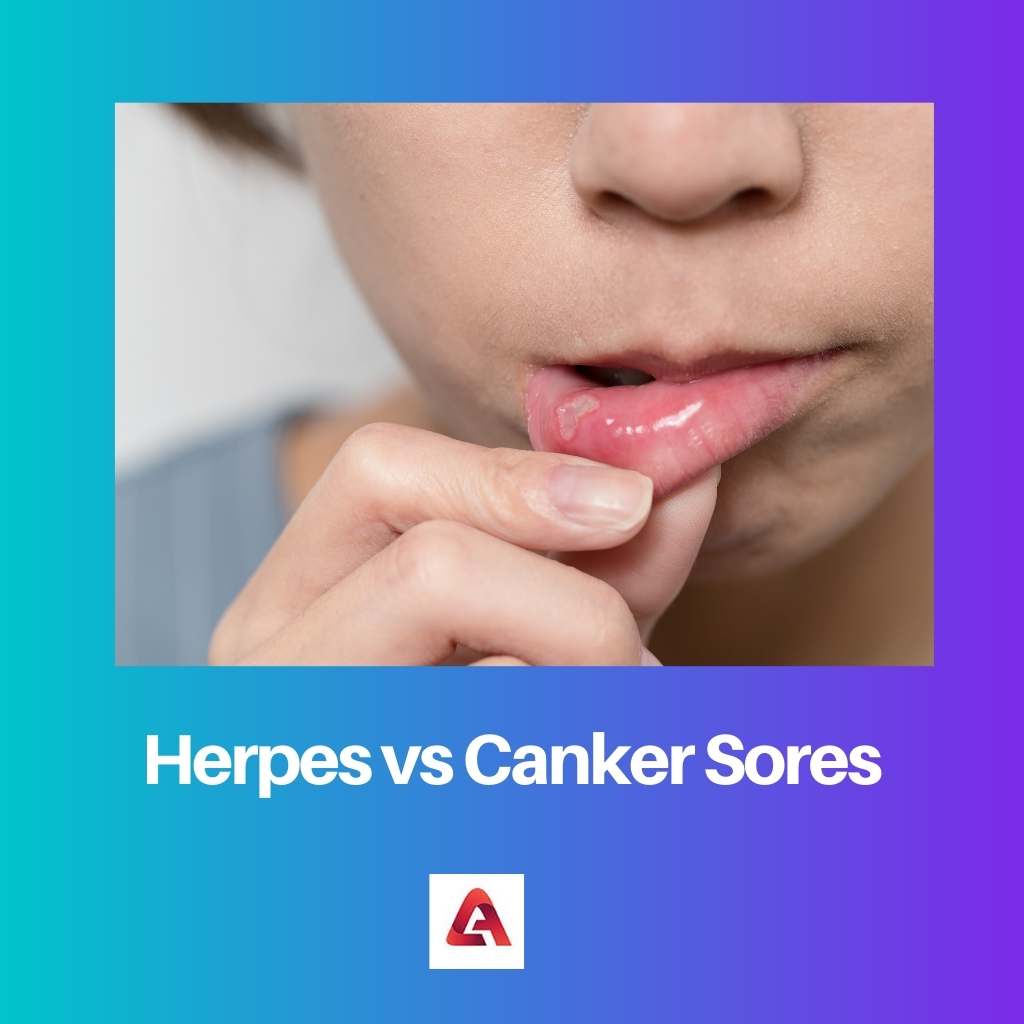 Herpes vs aftas bucales