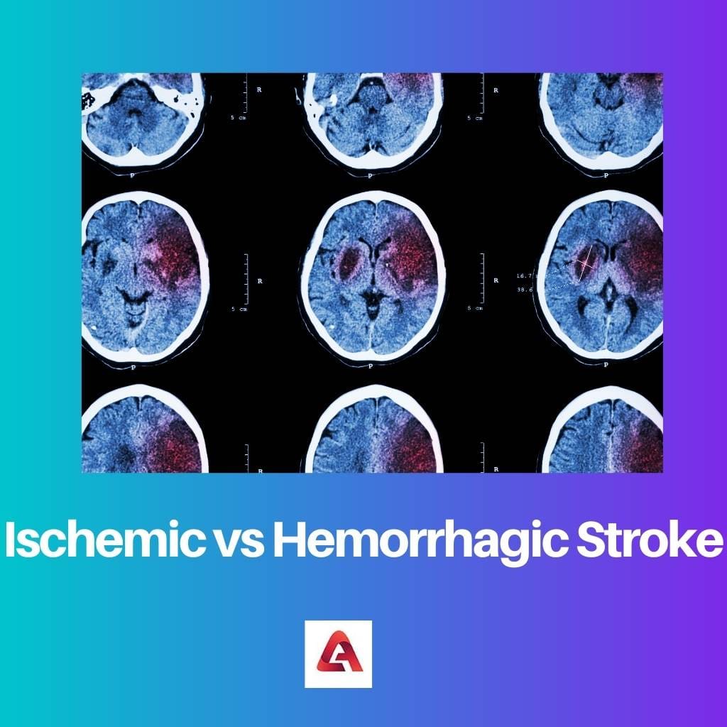 Ischemic vs Hemorrhagic Stroke