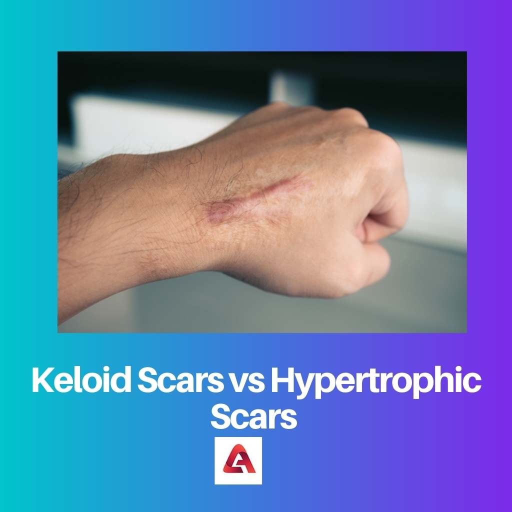 Cicatrices chéloïdes vs cicatrices hypertrophiques