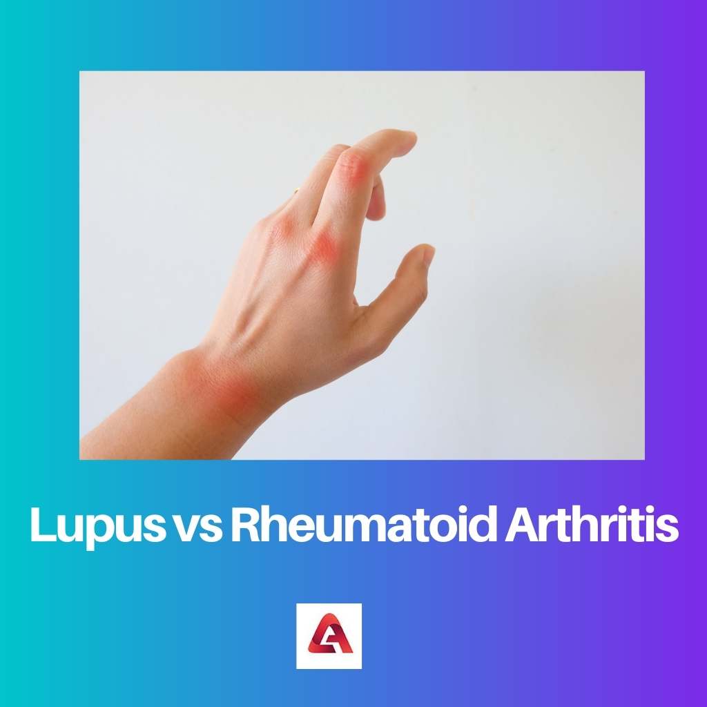 Lupus contro artrite reumatoide