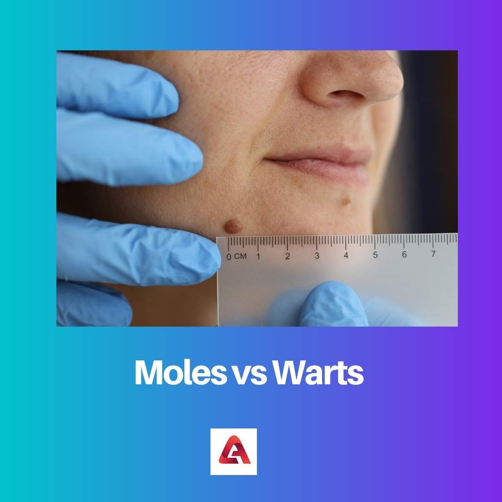 Moles vs Warts