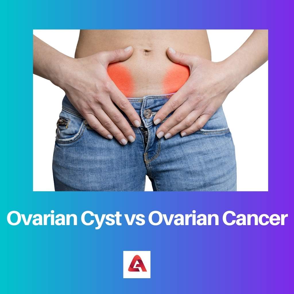 Cisti ovarica vs cancro ovarico