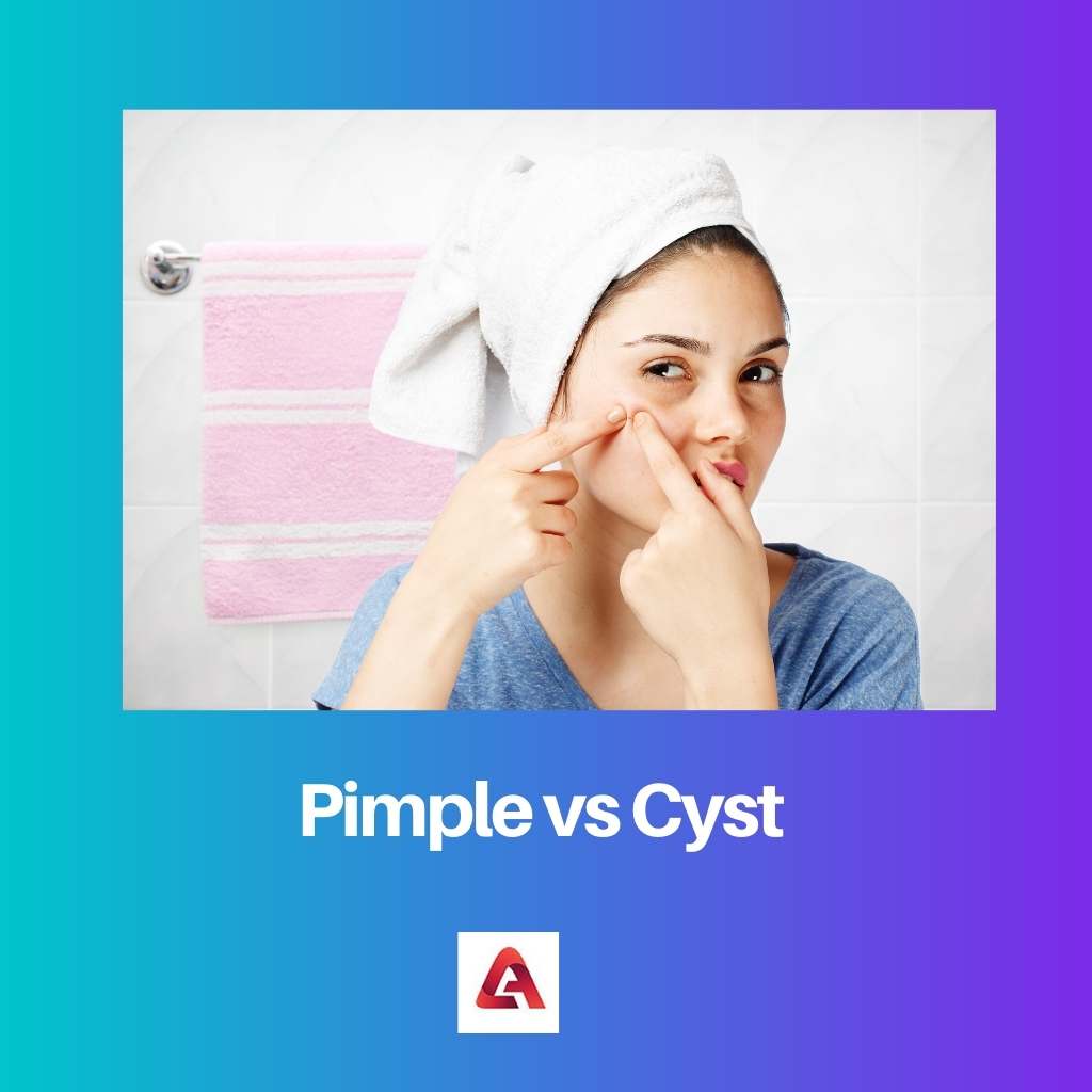 Pimple vs Cyst: Difference and Comparison