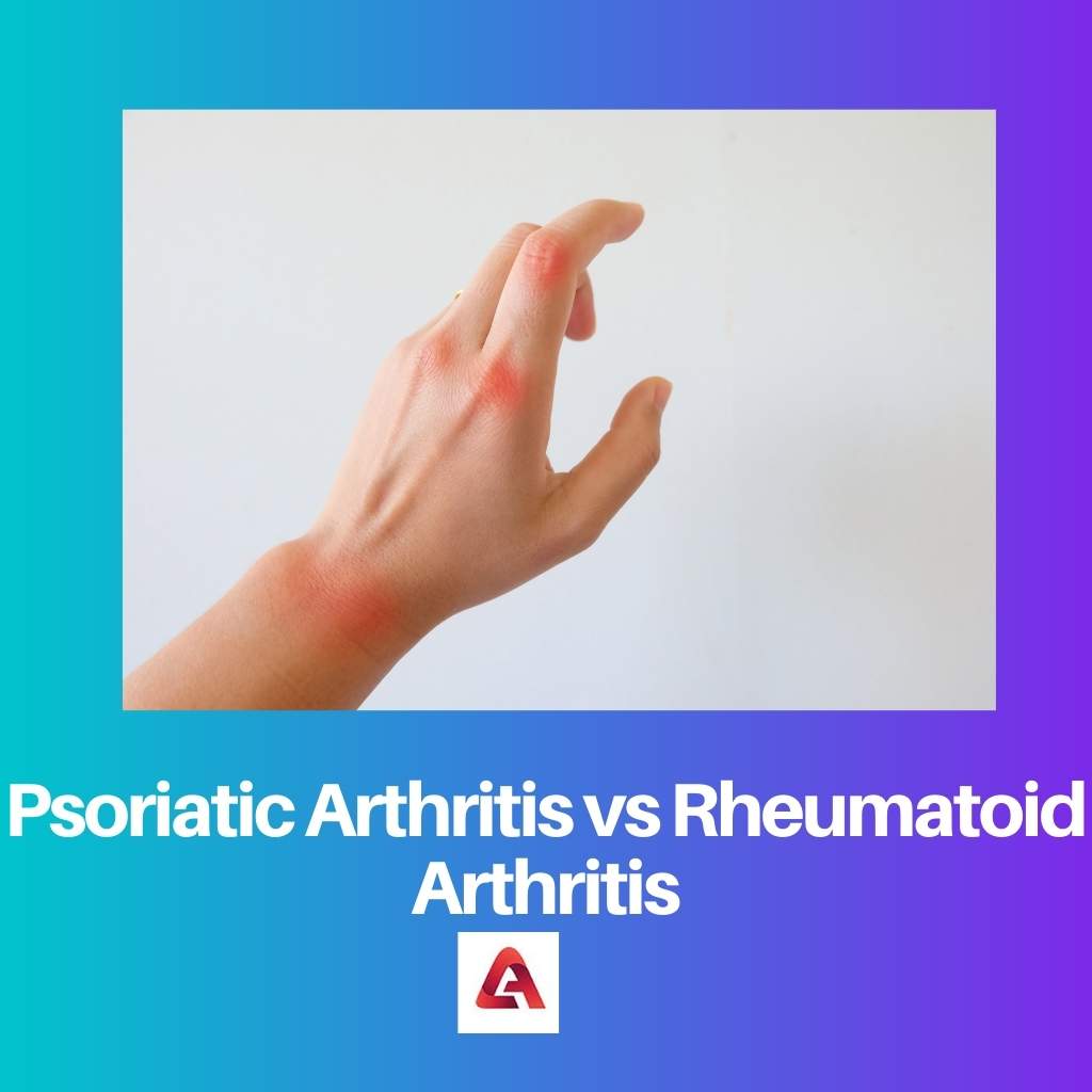 Arthrite psoriasique vs polyarthrite rhumatoïde