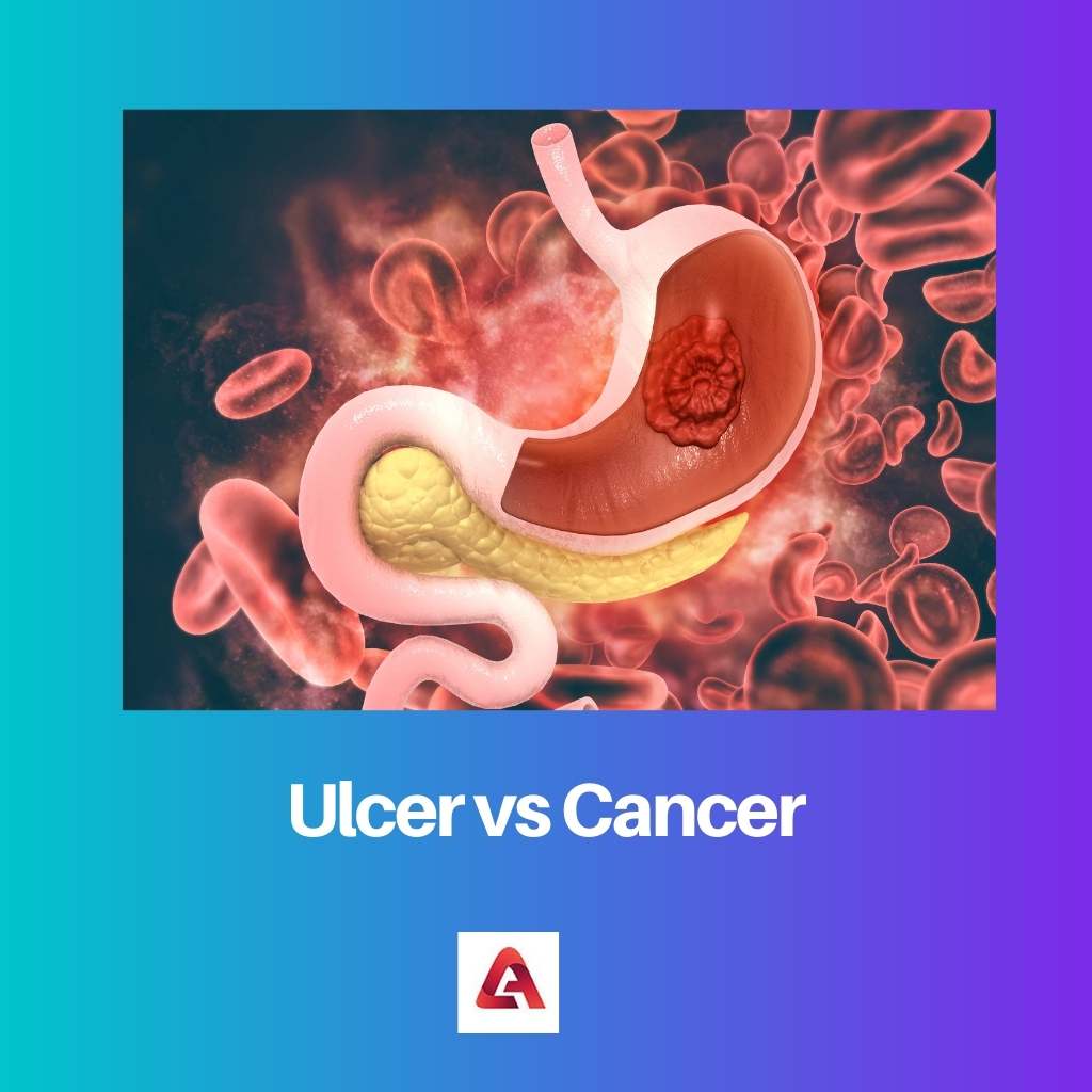 Loét vs ung thư