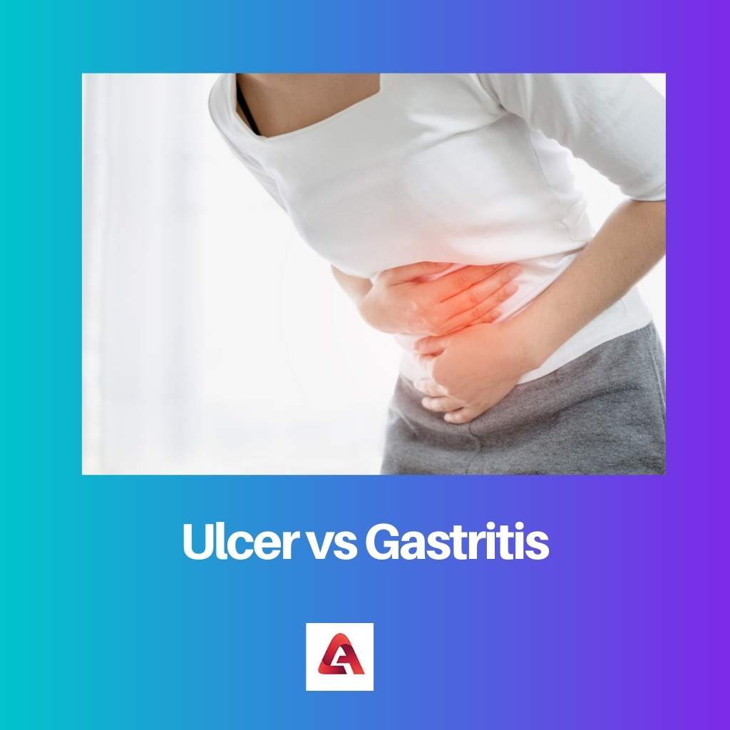 Ulcer vs Gastritis