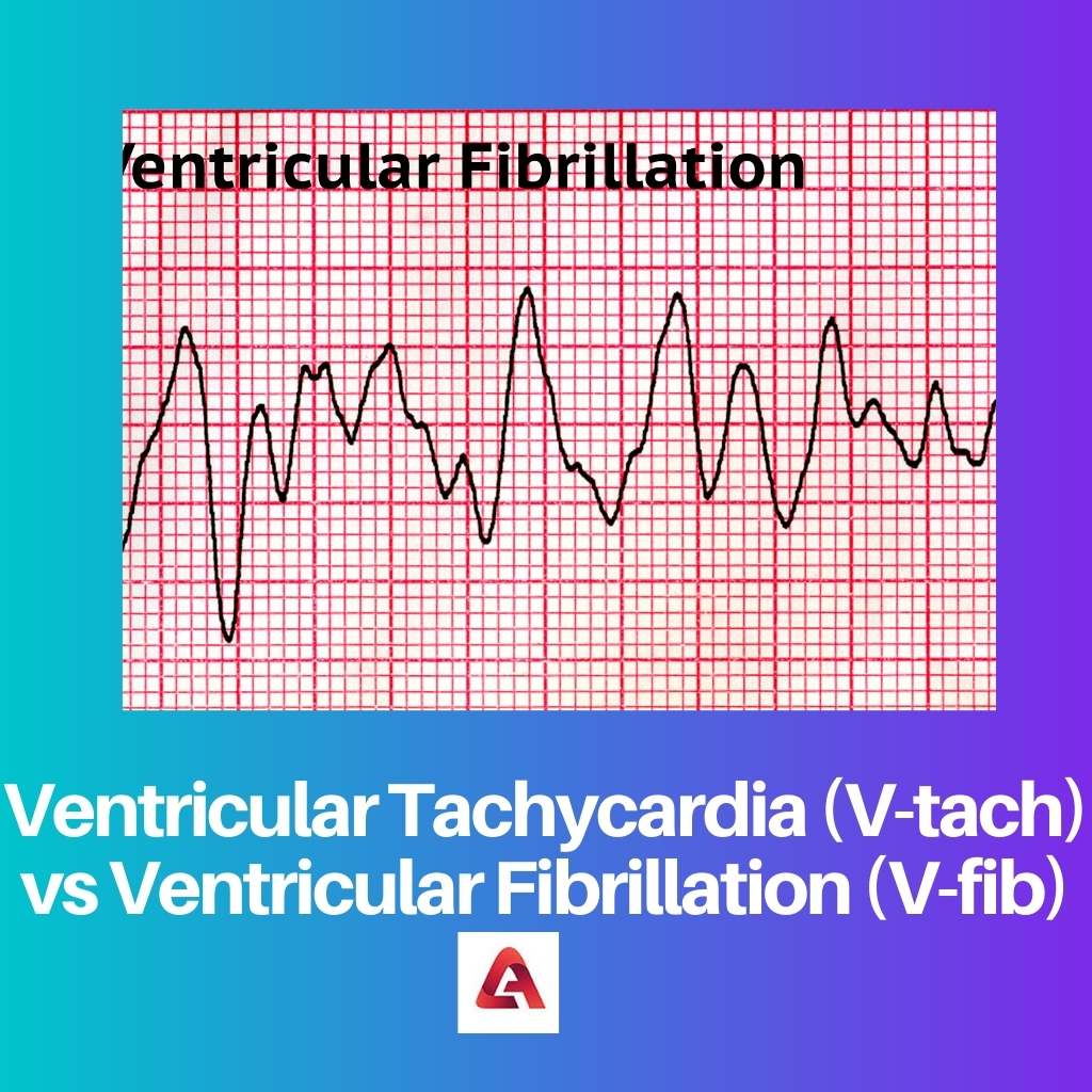 Ventricular Tachycardia V tach vs Ventricular Fibrillation V fib