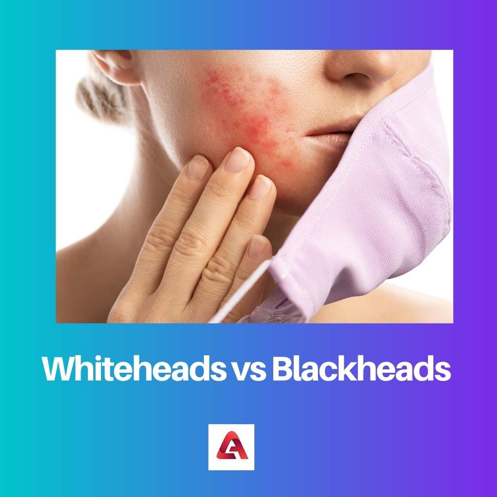 Whiteheads vs Blackheads