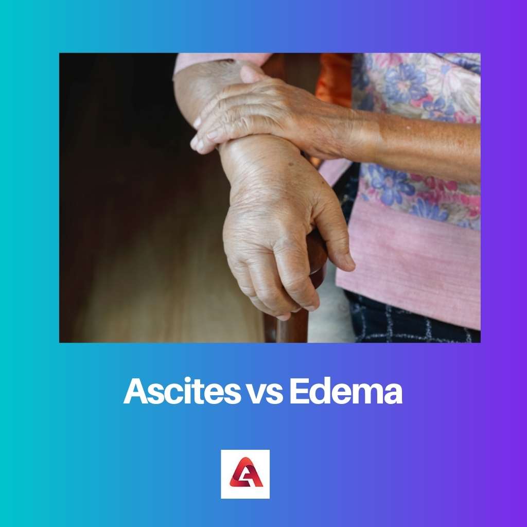 Ascites vs edém
