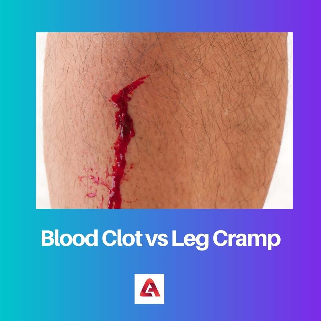 Blood Clot vs Leg Cramp
