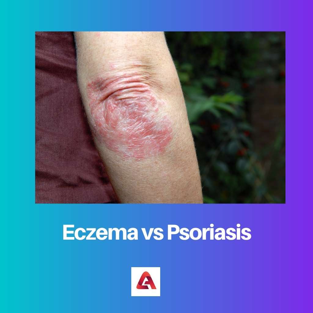 Eczeem versus psoriasis