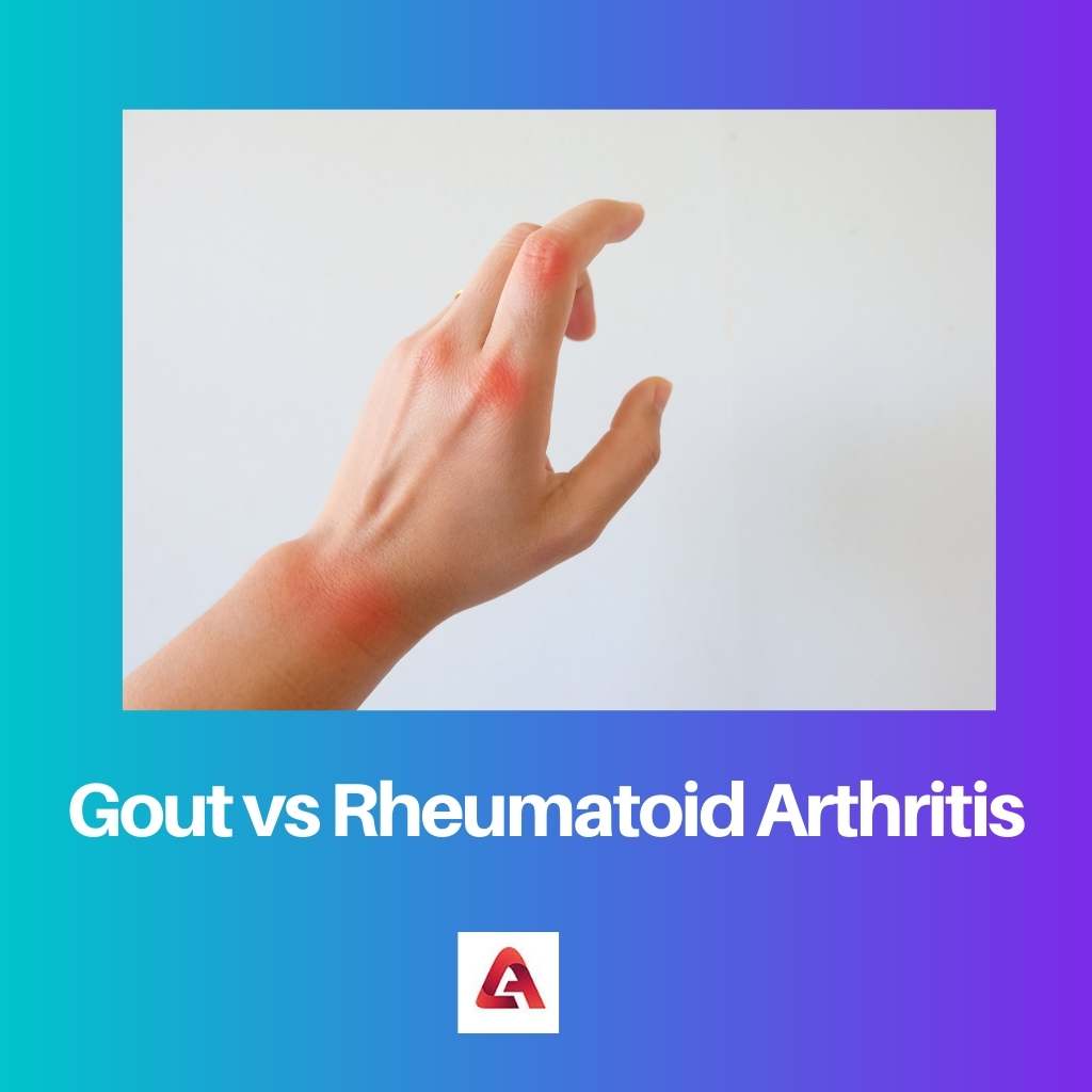 Gout vs Rheumatoid Arthritis