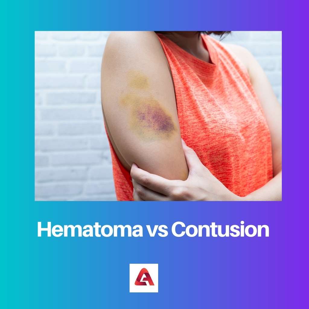 Hematoom versus kneuzing