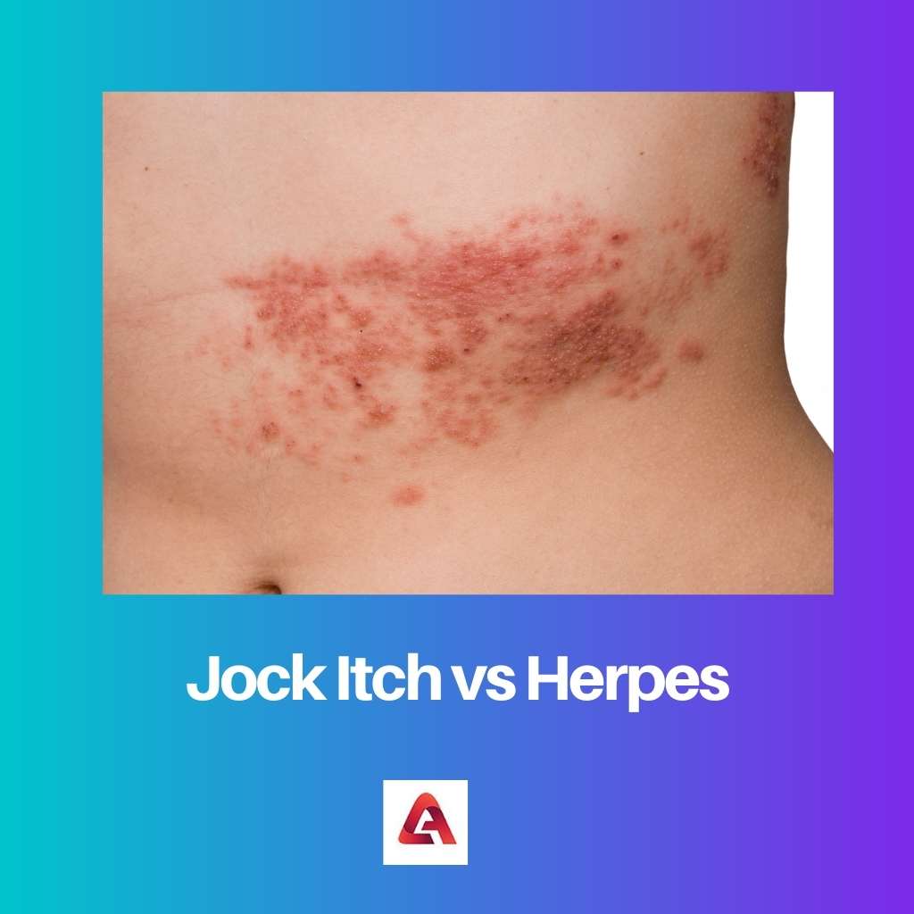 Jock Itch protiv herpesa