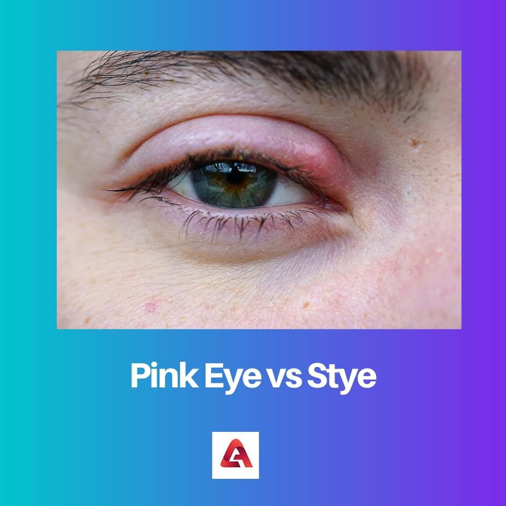 Mắt hồng vs Stye