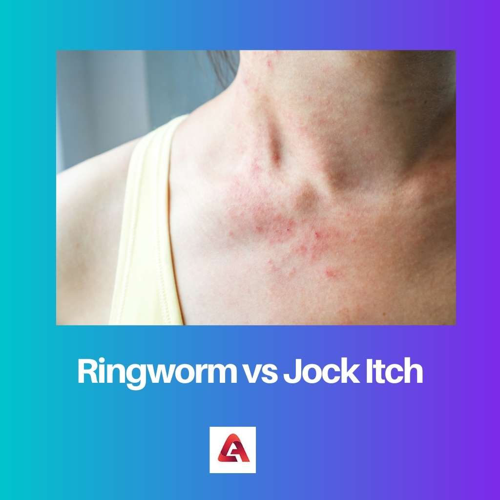 Ringworm vs Jock Itch