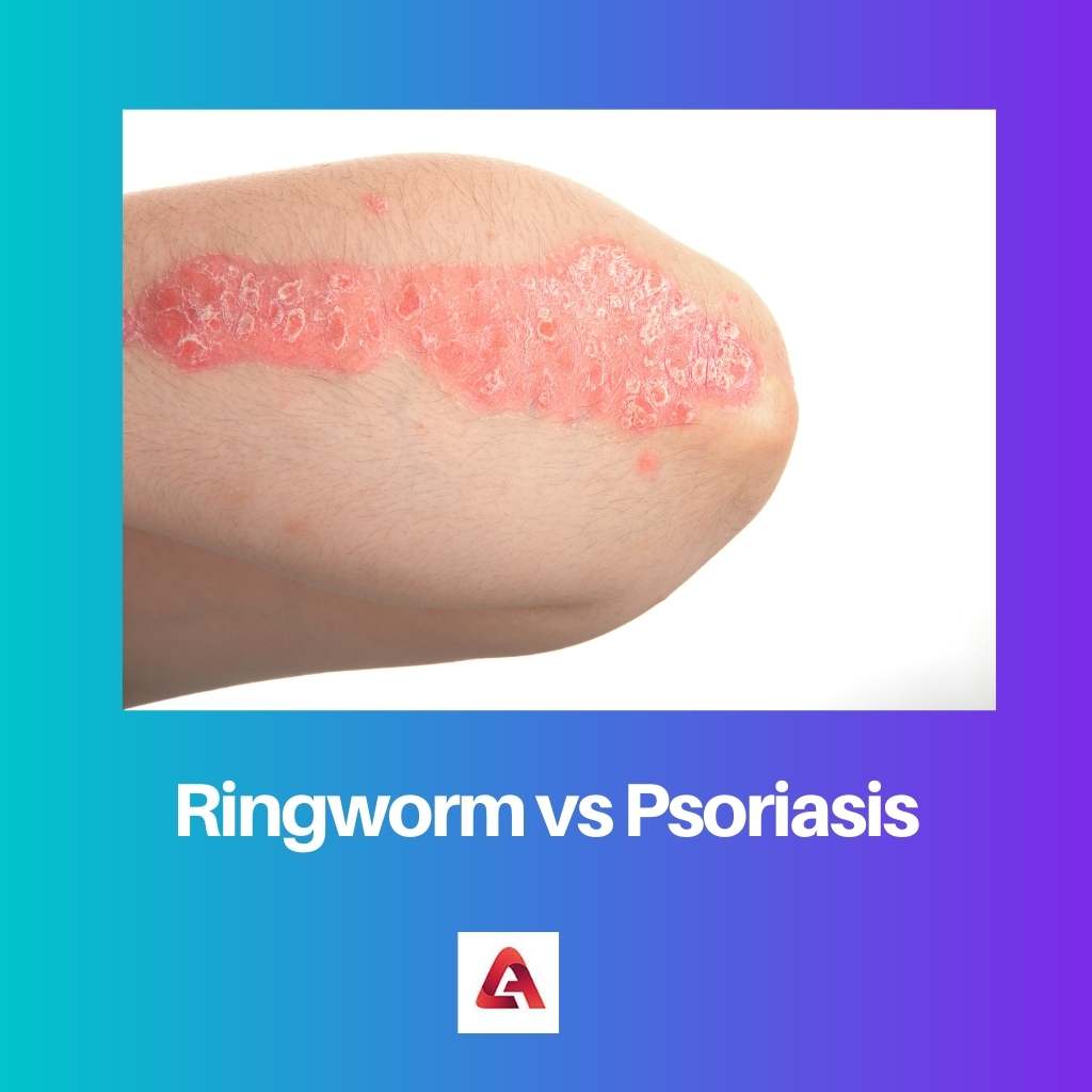 Ringworm vs Psoriasis