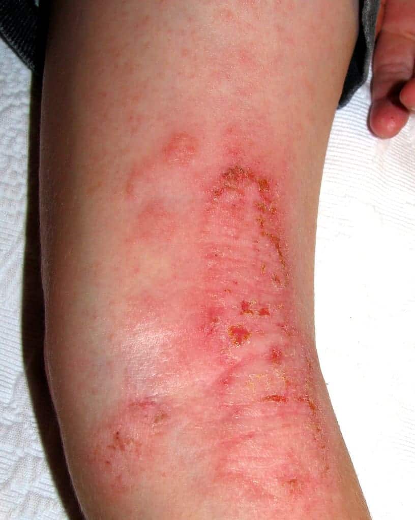 eczema 1