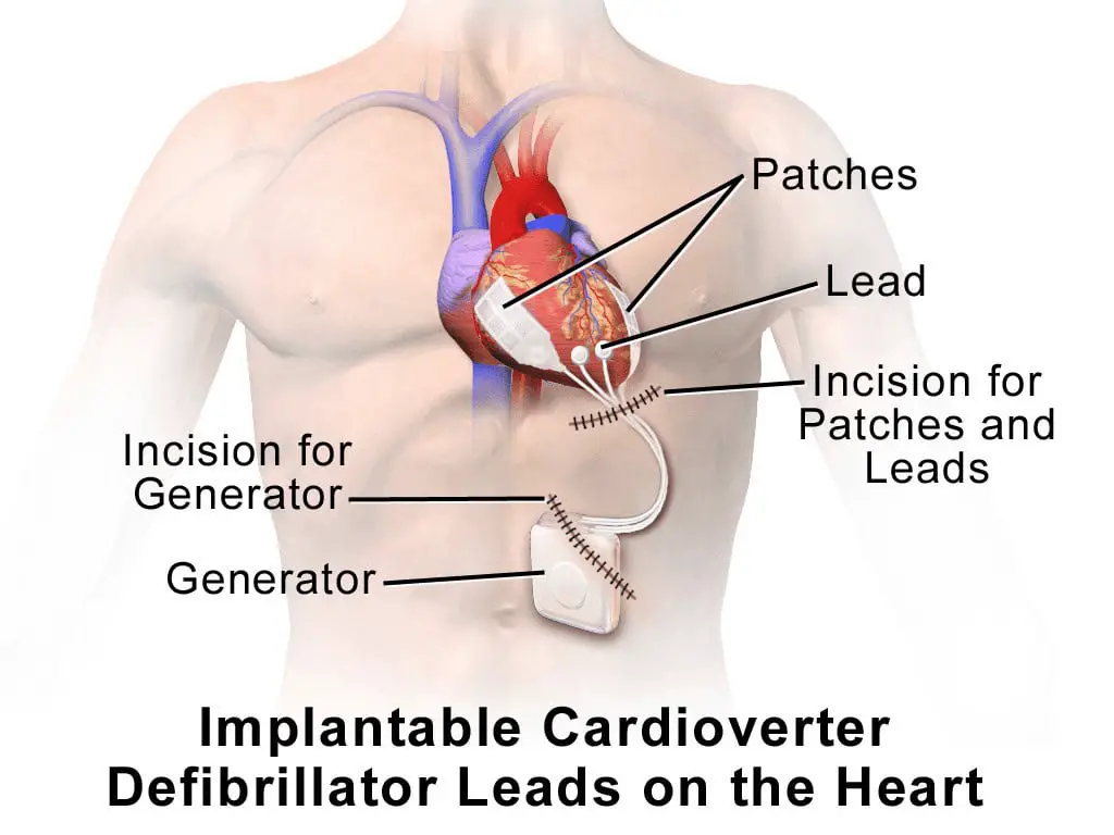 implantable cardioverter defibrillators
