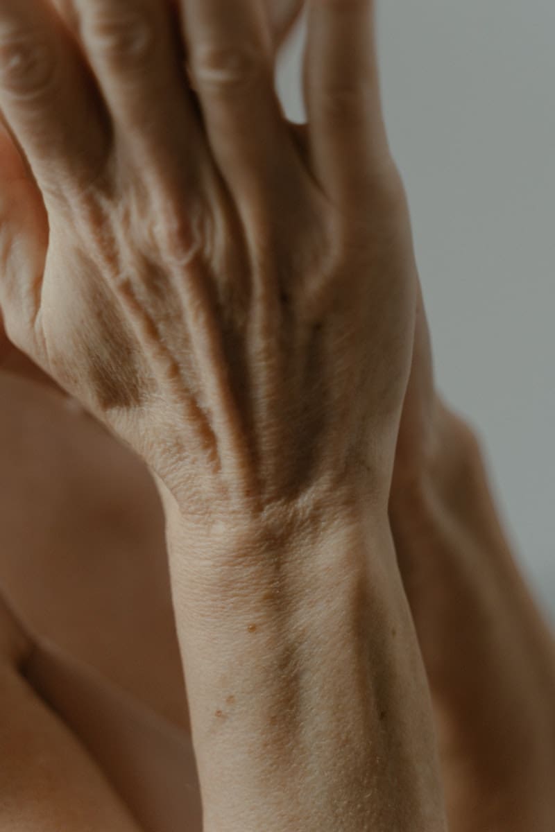 artrite reumática
