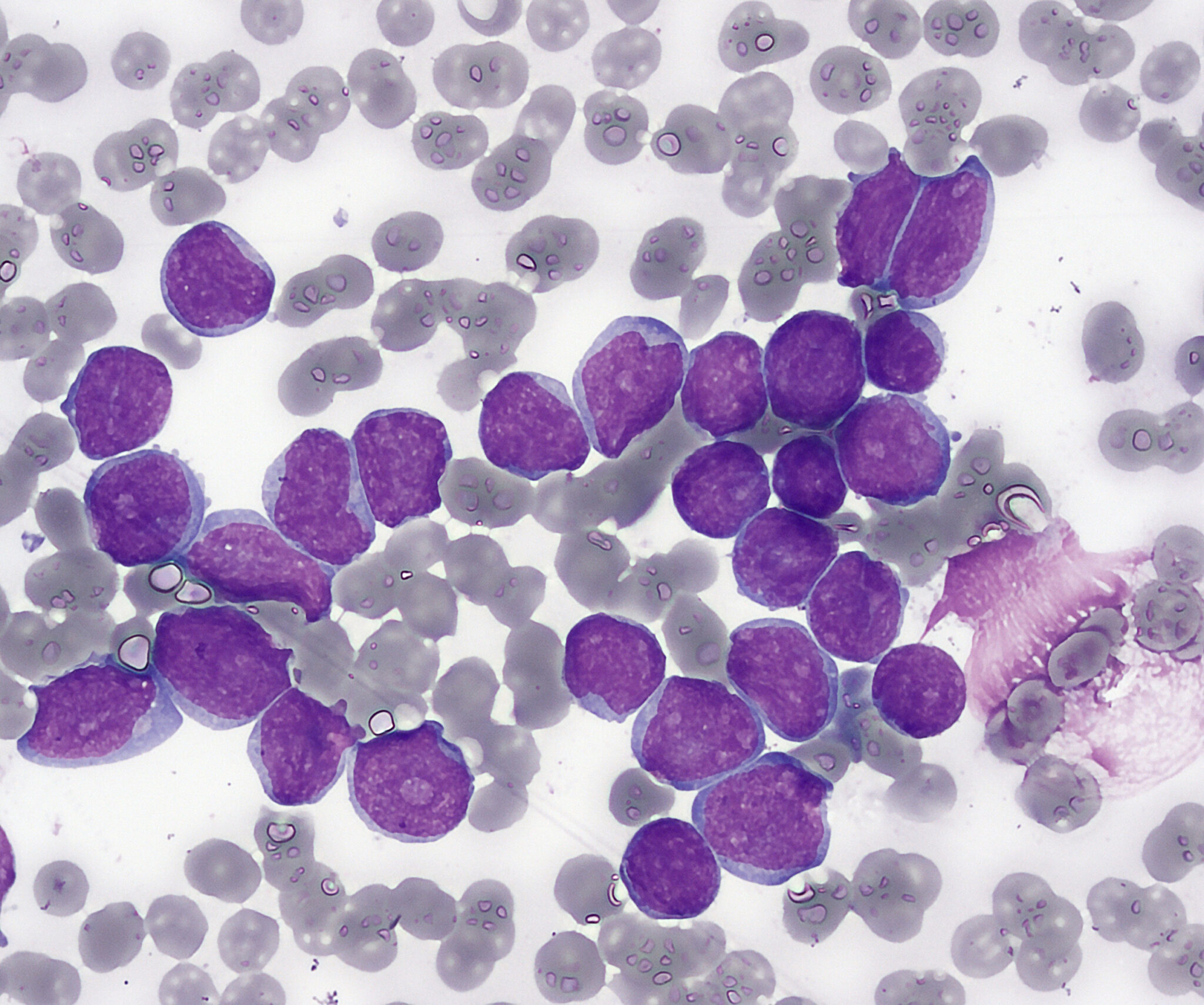 acute lymphoblastic leukemia