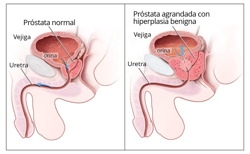 godartet prostatahyperplasi