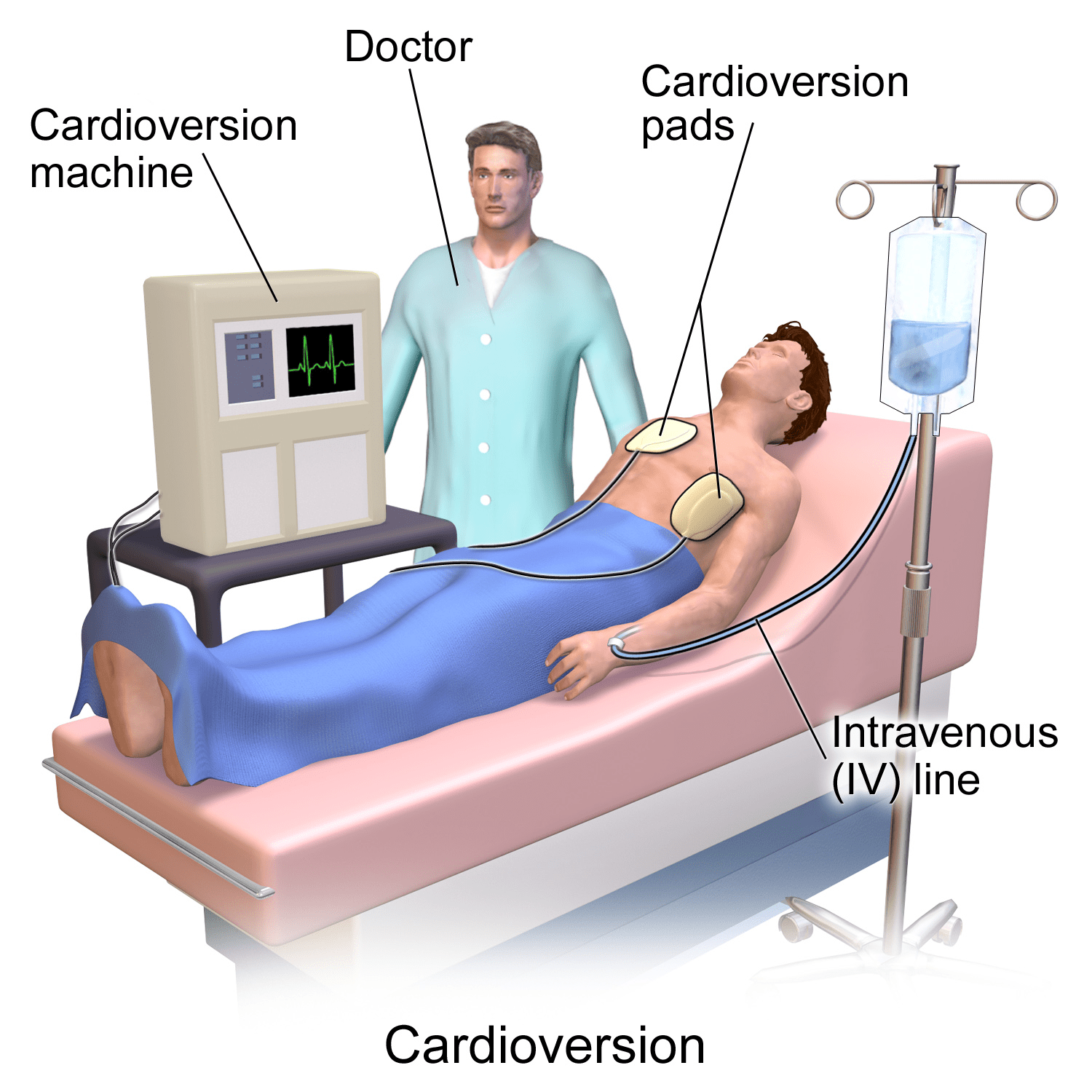 cardioversión
