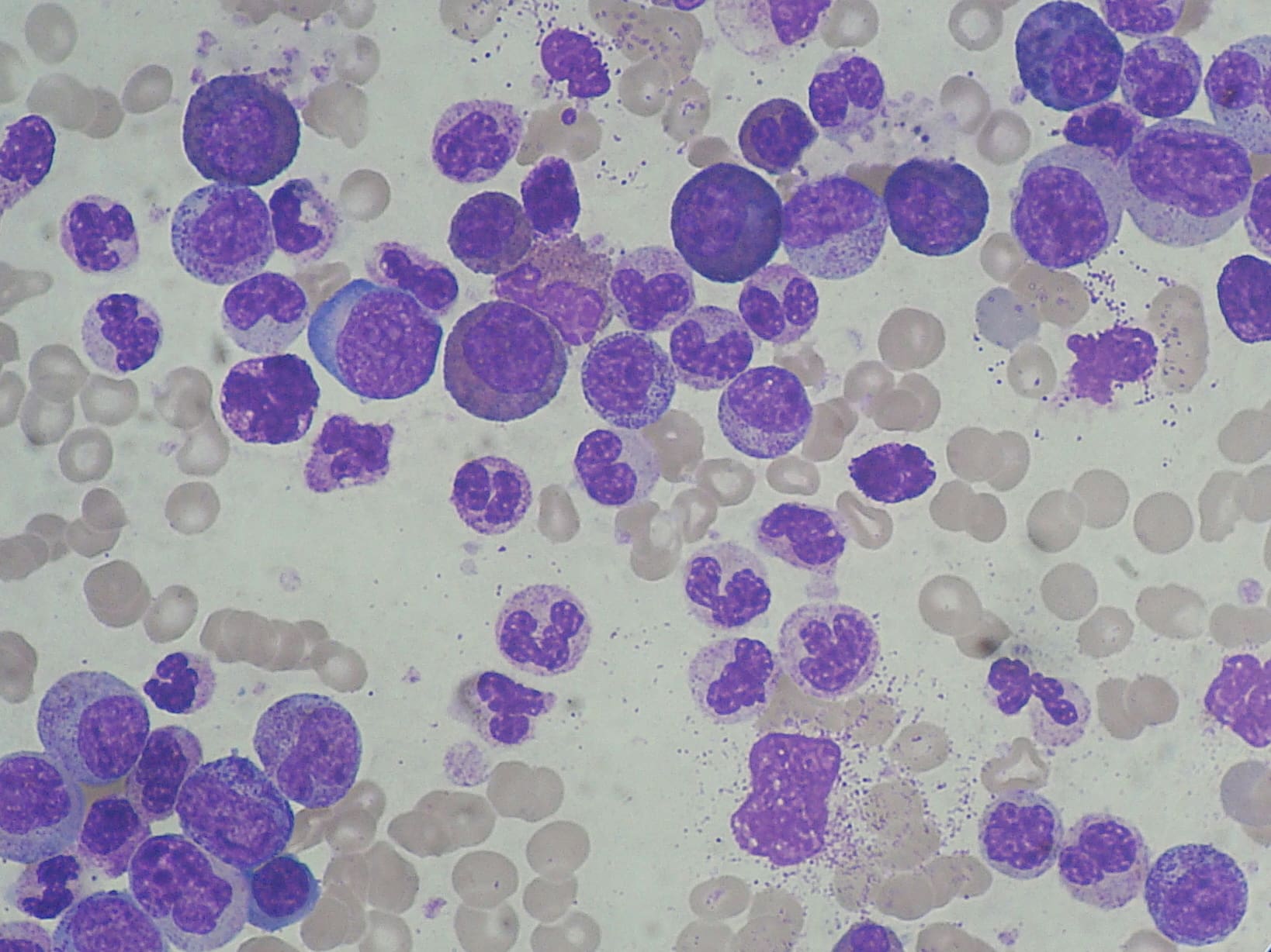 leukemia myeloid kronis