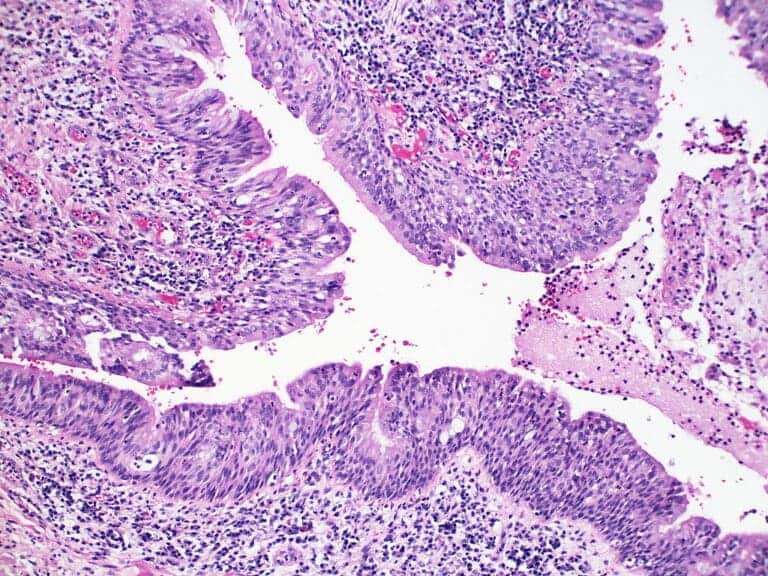 Dysplasia Vs Metaplasia Difference And Comparison