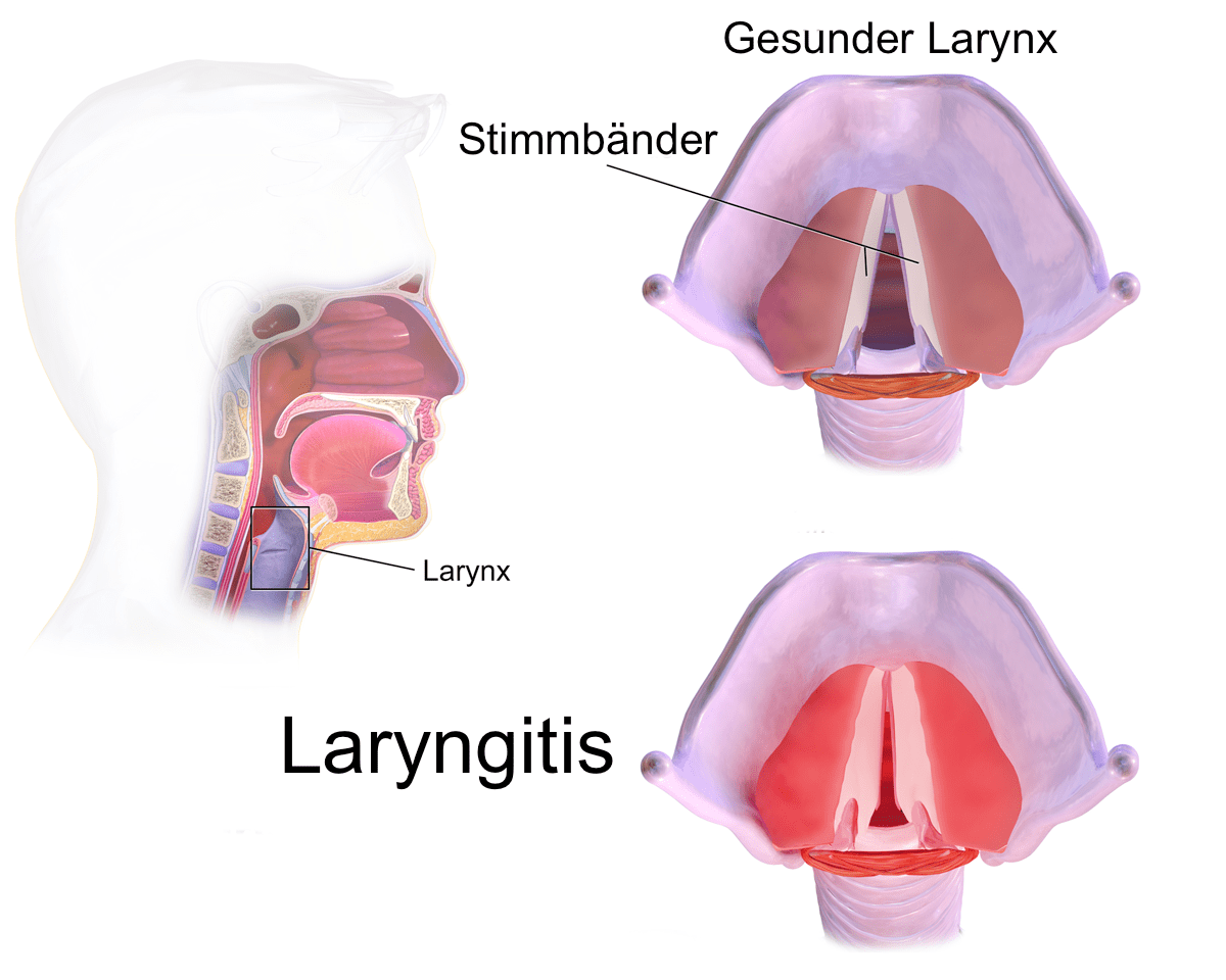 laringitis