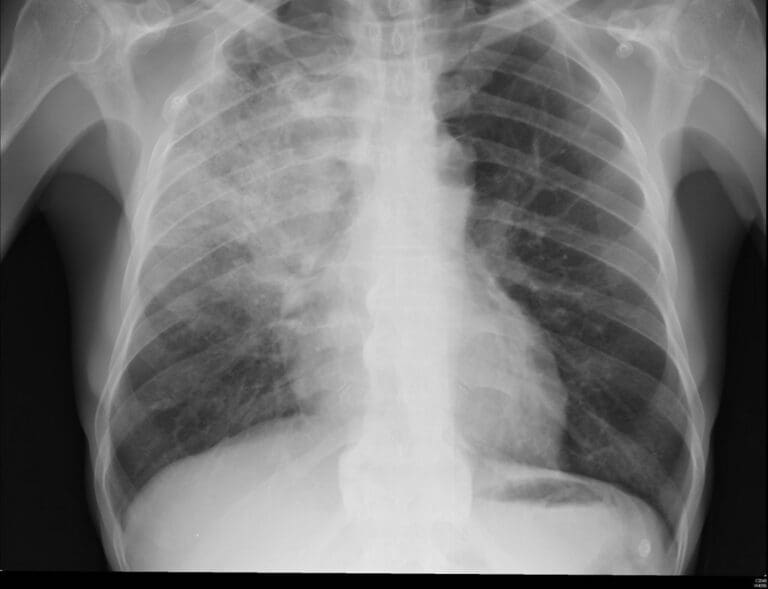 Pneumonia vs Congestive Heart Failure: Difference and Comparison