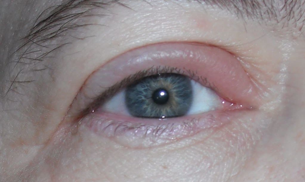 stye eye