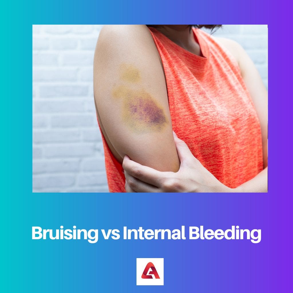 Bruising vs Internal Bleeding