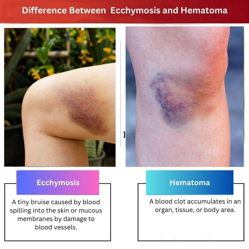 Difference Between Ecchymosis and Hematoma