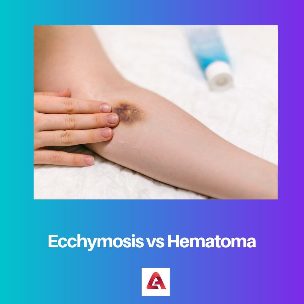 Ecchymosis vs Hematoma