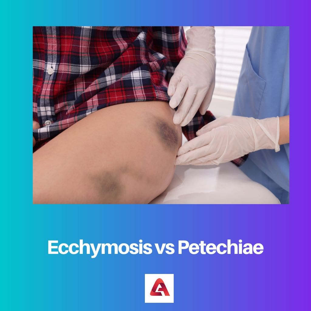 Ecchymose vs Pétéchies